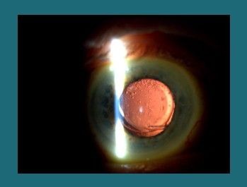 Select category such as IOLs, select an image, a blue border appears 